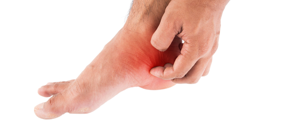 Diabetes and Feet – Athlete’s Foot